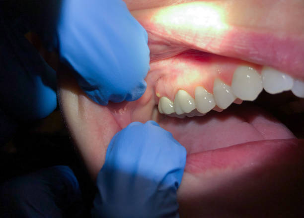 Best Root Canal Emergency Dentist  in Homer, MI